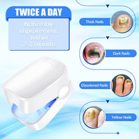 Rechargeable Nail Fungus Laser – Anti-Fungal Device Toenails, Hands & Feet (Home Use)